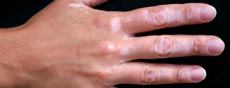 Vitiligo